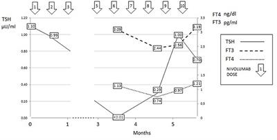 Nivolumab Induced Thyroid Dysfunction: Unusual Clinical Presentation and Challenging Diagnosis